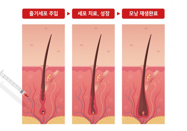 줄기세포 시술방법과 원리