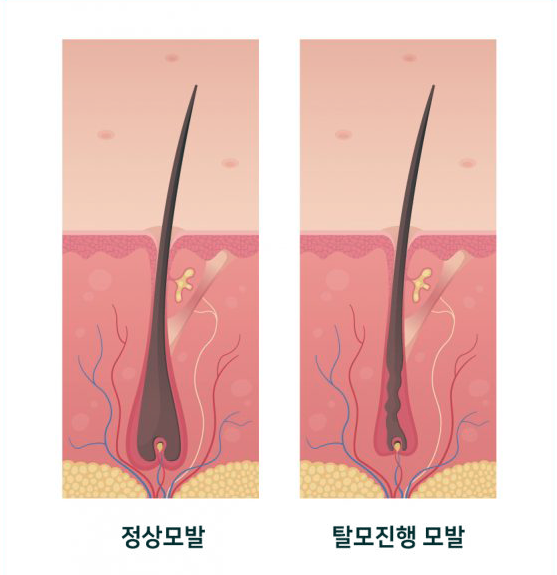 줄기세포 시술방법과 원리